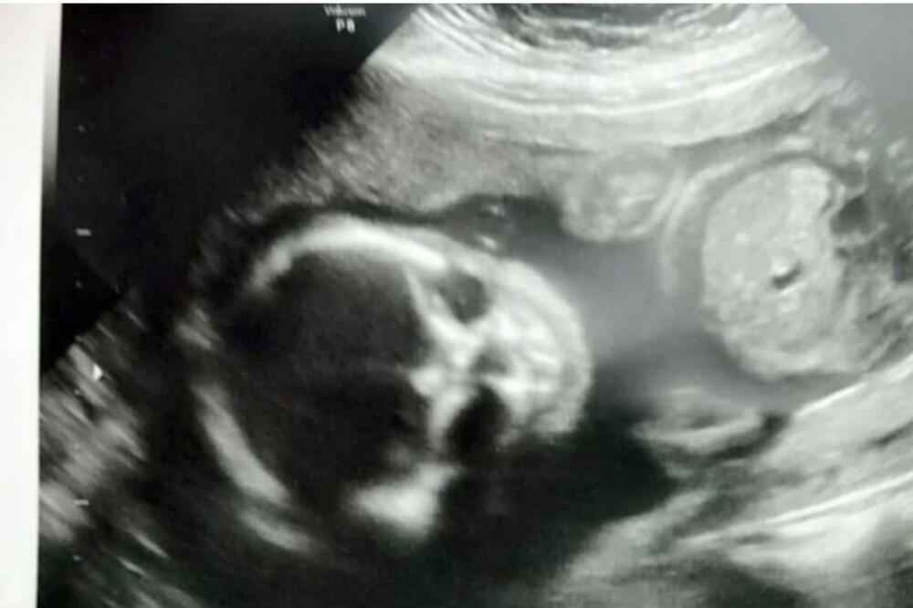 OTIŠLA JE NA ULTRAZVUK U 21. NEDELJI TRUDNOĆE: Čim je videla kako BEBA IZGLEDA NA SLICI, nije ŽELELA DA SE PORODI