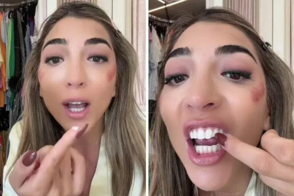 ZUB JOJ JE ISPAO DOK SE ŠMINKALA ZA ŽURKU, A ONA URADILA OVO: Ljudi ŠOKIRANO GLEDAJU i NE VERUJU, zubar VRIŠTAO