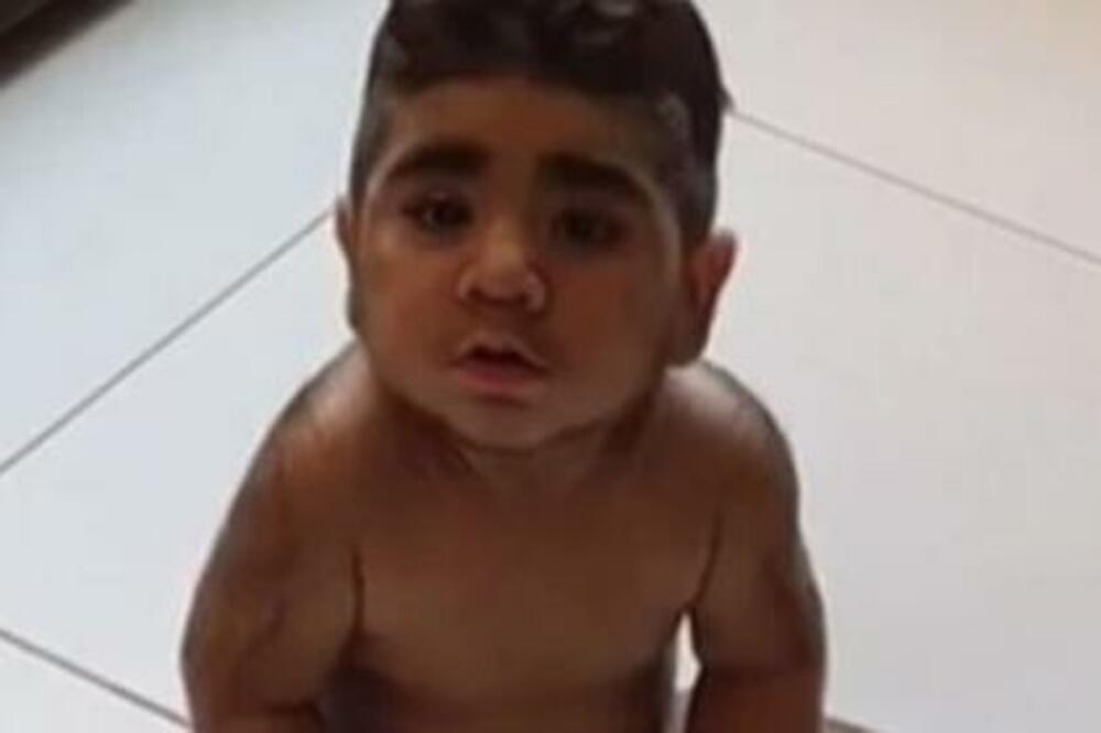 OVA BEBA JE MALJAVIJA OD VEĆINE MUŠKARACA: Dlake su joj SVUDA PO TELU, zovu je i VUKODLAKOM, a evo šta kaže LEKAR