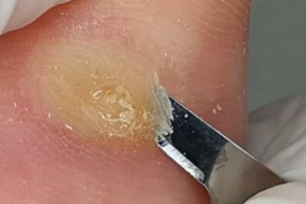 OVU KUĆNU BILJU STAVITE NA KURJE OKO I NESTAĆE OČAS POSLA: Naši stari se ODUVEK ovako LEČE, ne morate POD NOŽ