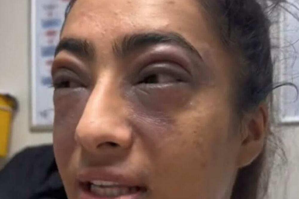 KADA JE DOTAKLA OVU NAMIRNICU UMALO NIJE OSLEPELA: Oči se zatvorile od OTOKA, nijedna BOLNICA nije znala ŠTA JE