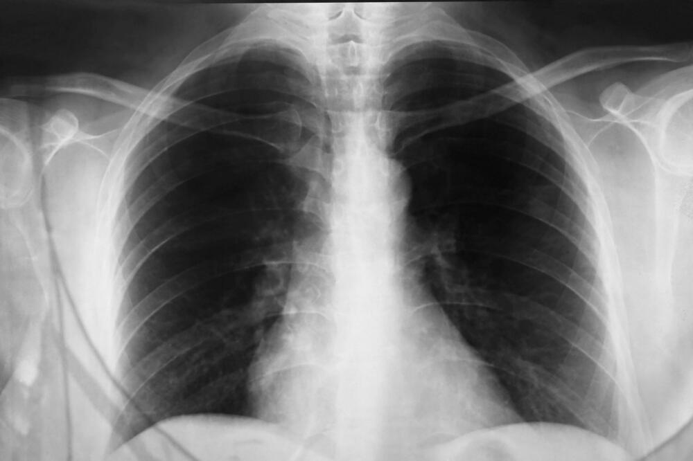 Pulmolog Miodrag otkrio koji je najbolji lek za upalu pluća: Ove 2 stvari zajedno su bolje i od antibiotika Pulmolog Miodrag otkrio koji je najbolji lek za upalu pluća: Ove 2 stvari zajedno su bolje i od antibiotika