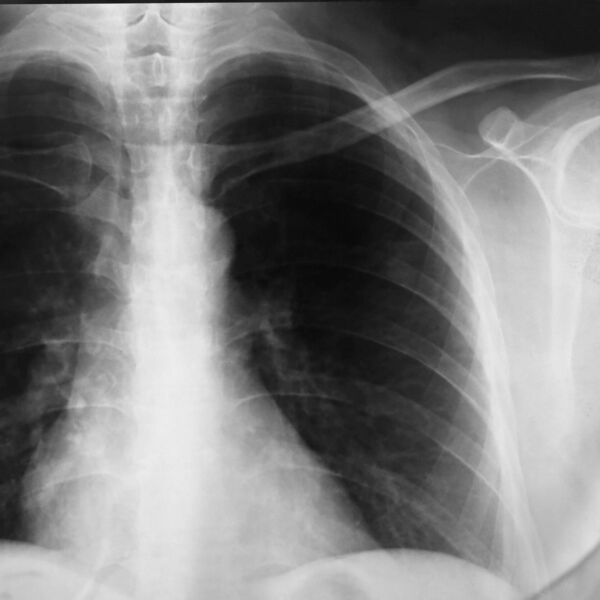 OD GNOJENJA DO OTKAZIVANJA ORGANA! Ovo su glavni simptomi UPALE PLUĆA! Odnela i slavnu OSKAROVKU