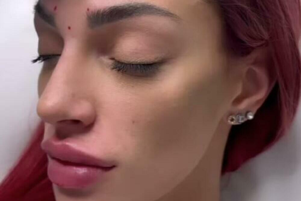 TARA SIMOV POKAZALA LICE NAKON KOREKCIJA: Odlučila se na RADIKALAN POTEZ, pa sebi iglom uradila OVO