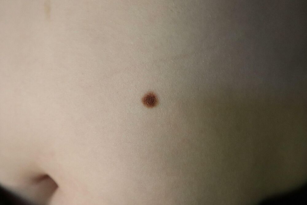 Ova vrsta melanoma je češća kod devojaka zbog povećanog izlaganja suncu.