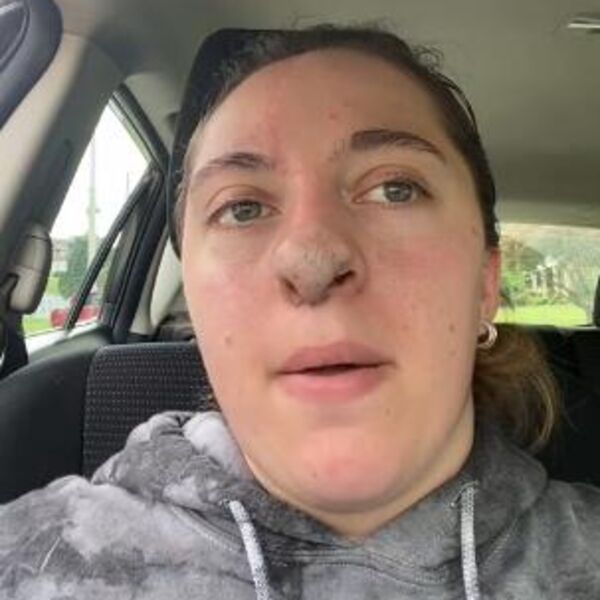 DEVOJKU NAPAO PAS I VUKAO KAO KRPENU LUTKU: Ujeo je za NOS, a sada joj na licu RASTE najgadnija stvar (VIDEO)