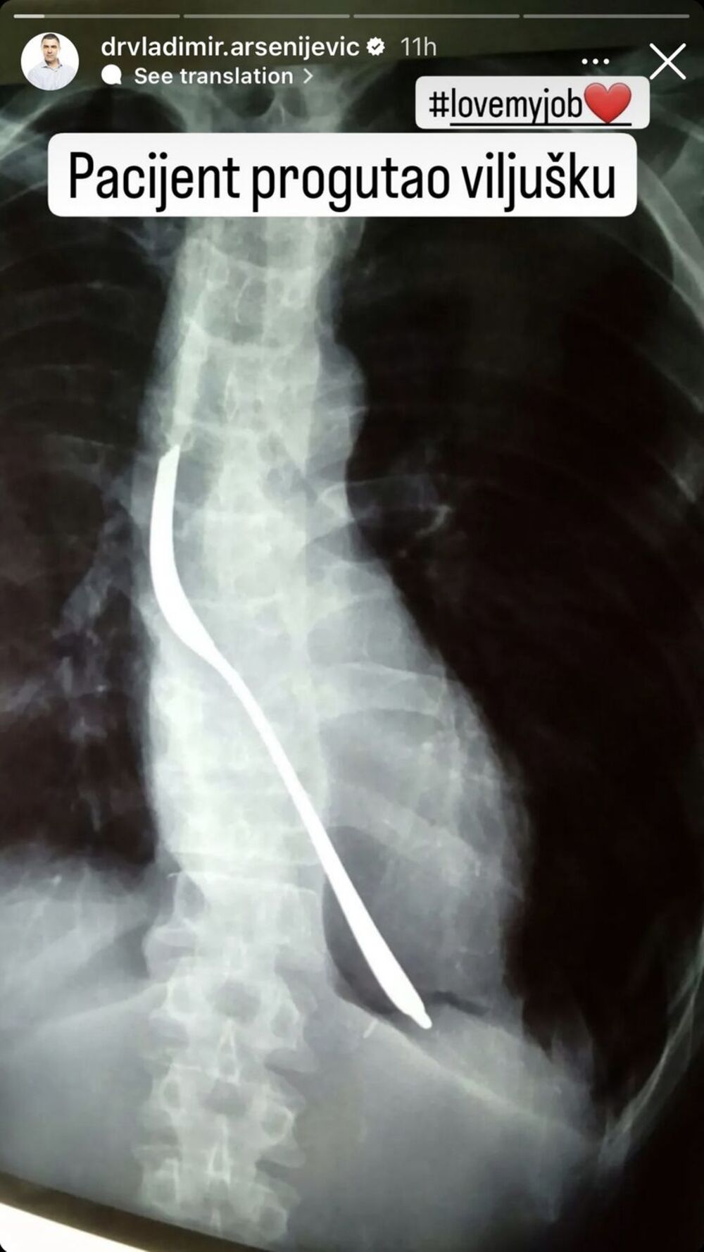 Pacijent progutao viljušku