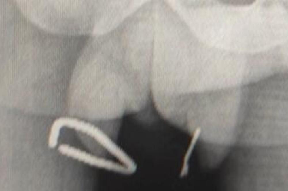 ŽALIO SE NA BOLOVE U STOMAKU, A ONDA JE USLEDILO NEŠTO ŠTO JE ZGROZILO I LEKARE: Evo šta su mu našli u TESTISIMA