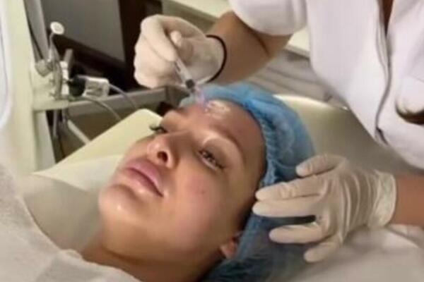 AU, MAŠALA! Luna Đogani se BOCKA na skoro svako "CRVENO SLOVO" Evo šta je sada RADILA NA LICU (FOTO)