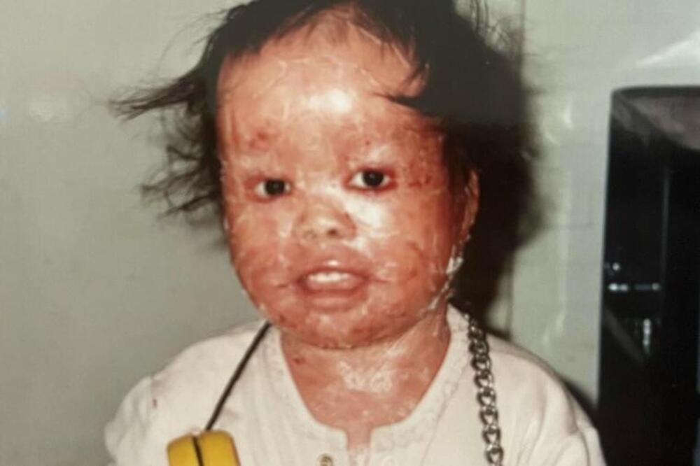 USVOJILI SU DETE SA CRVENOM KOŽOM I MALI ŠANSAMA ZA PREŽIVLJAVANJE! U ono što je izrasla se PREPRIČAVALI, ali...