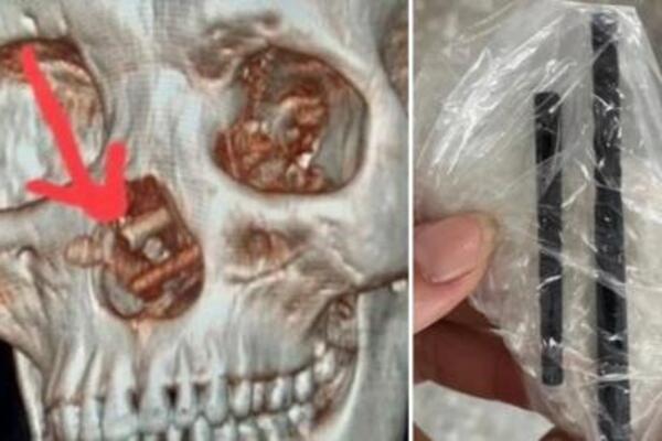 IMAO JE NESNOSNE GLAVOBOLJE, A ONDA JE OTIŠAO POD CT SKENER: Ono što su PRONAŠLI TAMO, lekare je bacilo u NEVERICU