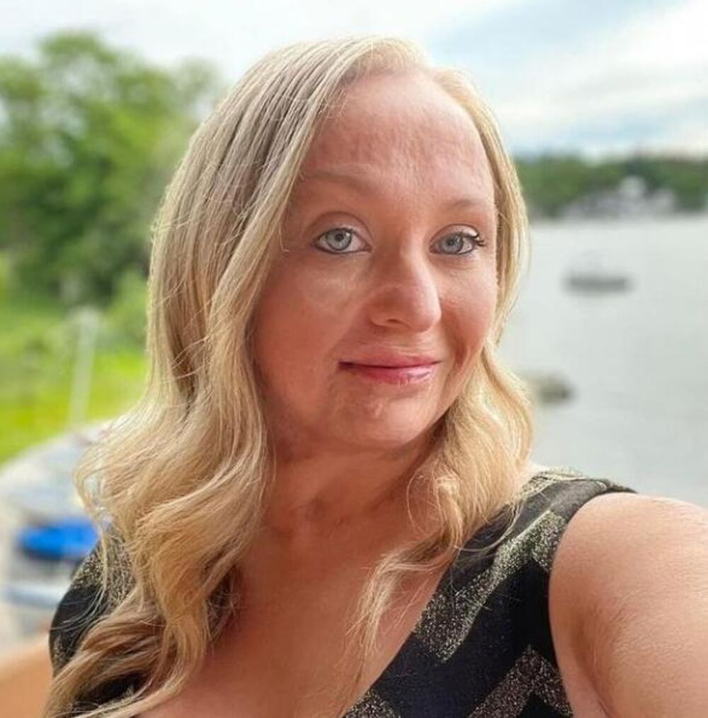 Opekotine od benzina