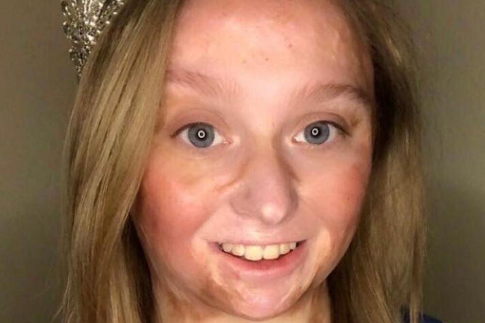 MAJKA HTELA DA JE SPASE VAŠAKA PA JOJ SPALILA LICE: Opekotine su ostale trauma, ali ova UŽASNA stvar joj ne da mira