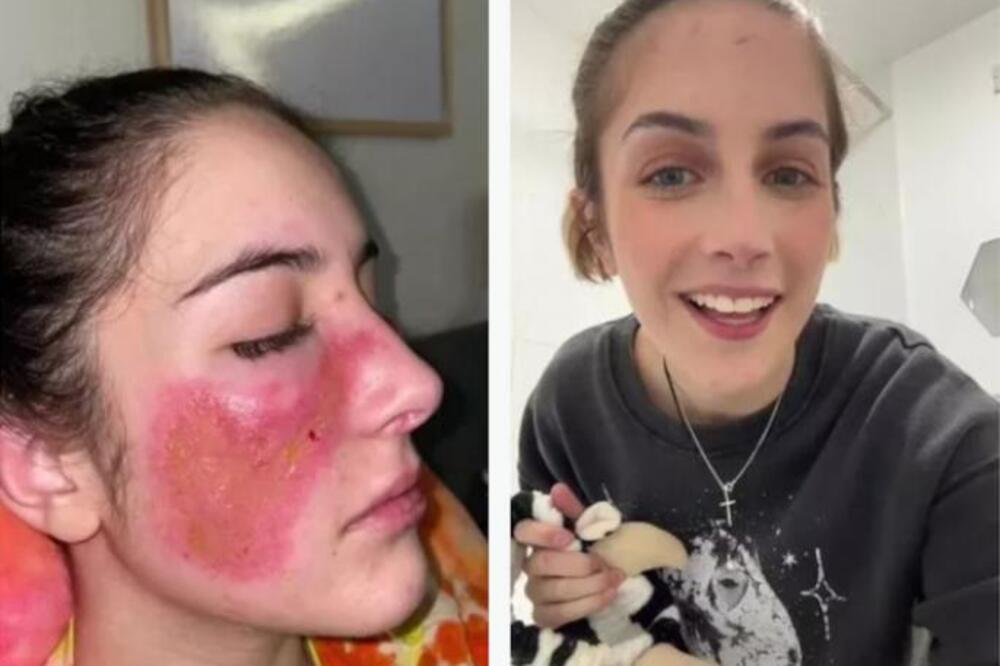 "TOLIKO SAM ALERGIČNA NA SEBE DA SE OSEĆAM KAO DA GORIM": Lekari ne znaju šta kako da POMOGNU ovoj devojci (FOTO)