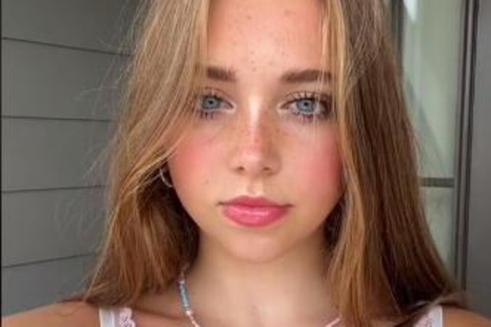 OVU PRELEPU DEVOJKU SVI IZBEGAVAJU ZBOG NEOBIČNOG SINDROMA: Pola života je LAGALA o svom izgledu, a onda...(VIDEO)