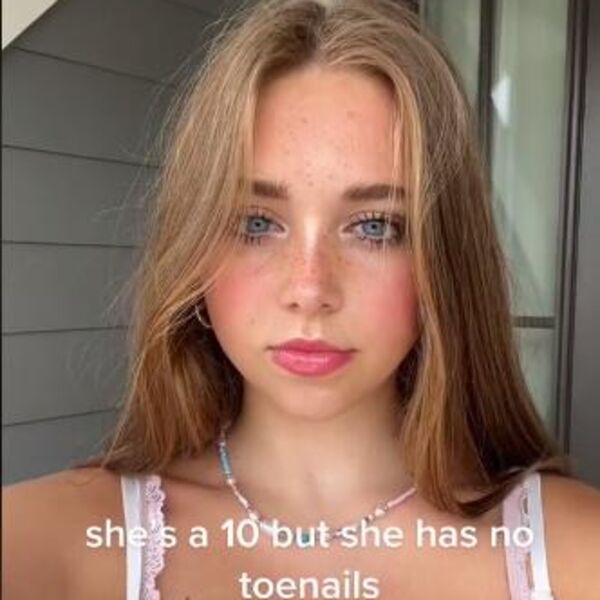 OVU PRELEPU DEVOJKU SVI IZBEGAVAJU ZBOG NEOBIČNOG SINDROMA: Pola života je LAGALA o svom izgledu, a onda...(VIDEO)