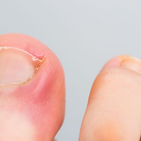 PAZITE SE! Ako nokti pokažu ovaj znak, idite odmah kod lekara: Upozorenje na PROBLEM koje može biti OZBILJAN