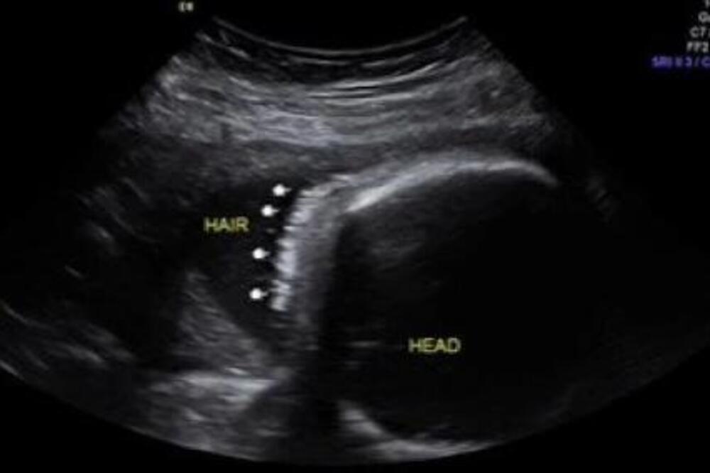 MAJKA SE SABLASNULA KADA JE VIDELA OVU TAČKU NA ULTRAZVUKU: Čim su joj lekari otkrili ŠTA JE, pala je u ŠOK STANJE