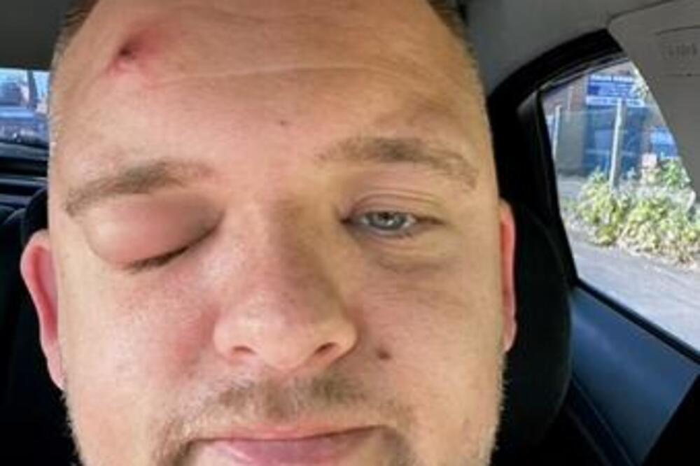 IMAO BUBULJICU NA ČELU A ONDA MU JE IZ IZRASLINE ISKOČILO OVO: Počelo je da se KOPRCA, nije mogao da veruje ŠTA JE