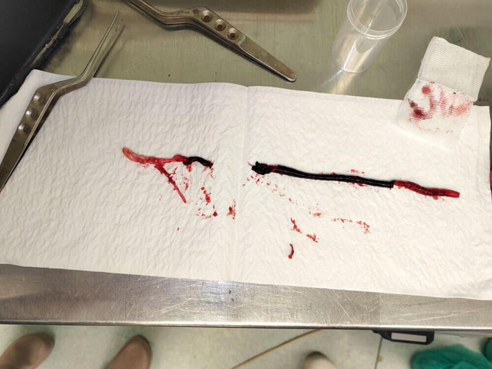 OVO JE IZVAĐENO IZ MLADIĆEVE BUTNE ARTERIJE