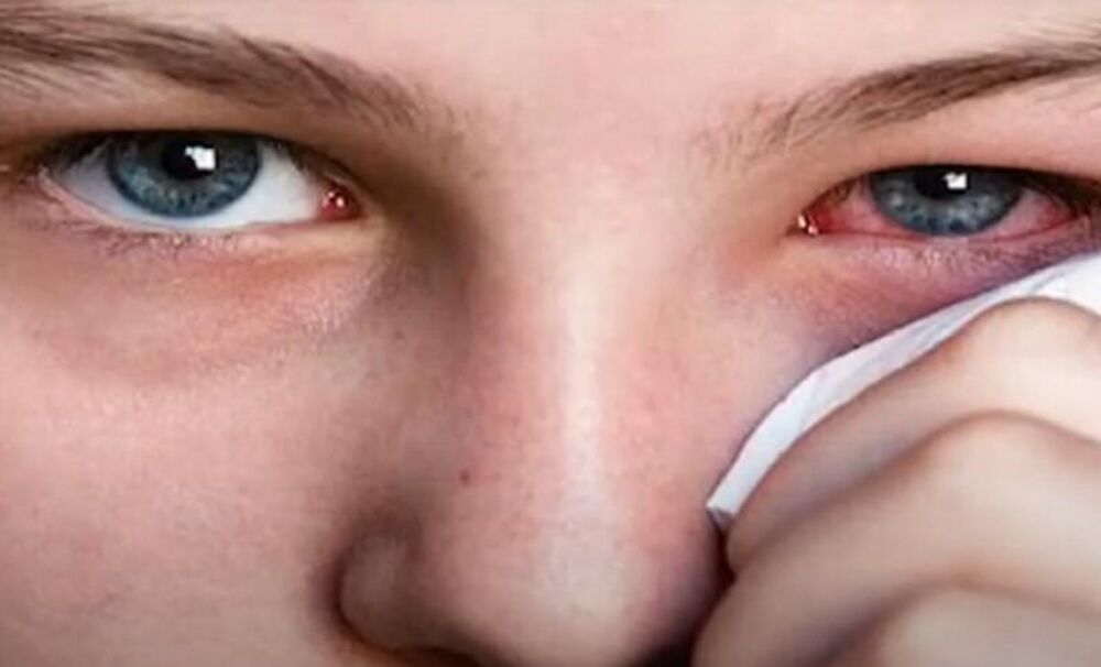 Trljanjem očiju možemo podstaći širenje infekcija kao što je konjuktivitis