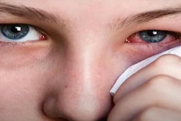 OVO SU NAJČEŠĆI SIMPTOMI KONJUKTIVITISA: Bolest je toliko ZARAZNA da se časkom prenosi, evo kako to da SPREČITE