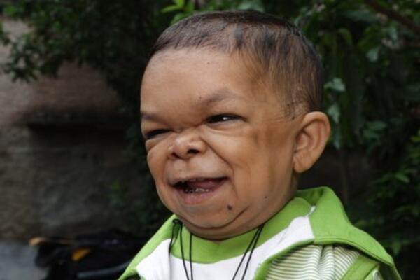 OVO NIJE BEBA NA SLICI VEĆ MUŠKARAC OD 25 GODINA SA OZBILJNIM POREMEĆAJEM: Najniži je u državi i izgleda OVAKO