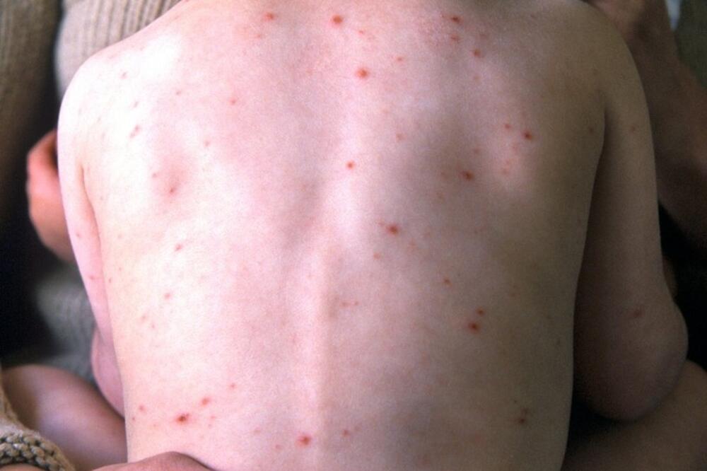 BATUT SAOPŠTIO NAJNOVIJE PODATKE: U Srbiji registrovana 32 slučaja morbila, najviše obolelih u ovom gradu