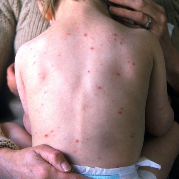 Dve nedelje od smrti dečaka (9) i dalje nema nalaza obdukcije! Imao boginje i temperaturu, lekar ga poslao kući