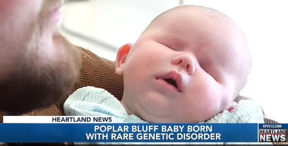 Beba rođena bez očiju