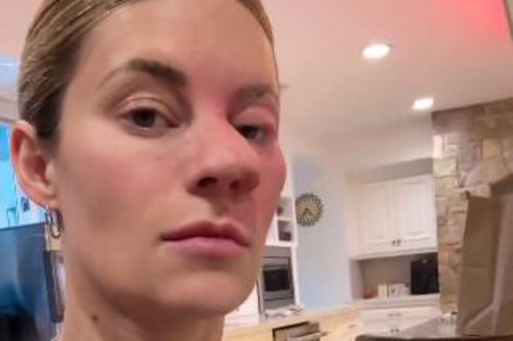 HANA JE UŠMRKALA PČELU U NOS DOK JE MIRISALA CVET, A ONDA JE USLEDIO HOROR: Posledice su bile KATASTROFALNE po nju