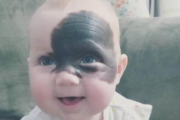 OVA BEBA IMA OGROMNU FLEKU NA LICU KOJA JE UPLAŠILA I NJENU MAJKU: Kad vidite šta je u pitanju IZNEVEROVAĆETE FOTO