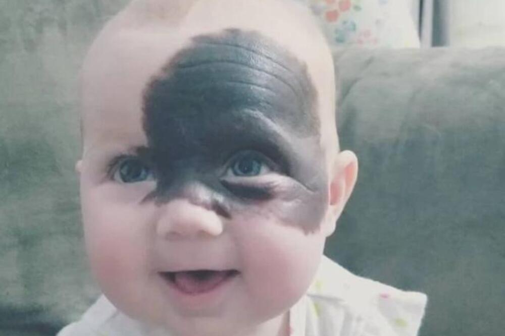 OVA BEBA IMA OGROMNU FLEKU NA LICU KOJA JE UPLAŠILA I NJENU MAJKU: Kad vidite šta je u pitanju IZNEVEROVAĆETE FOTO