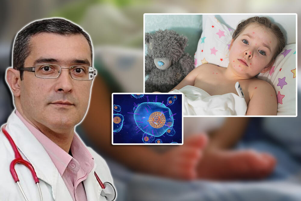 "AKO STE NA OVOLIKOM RASTOJANJU SA ZARAŽENIM, DOBIĆETE MALE BOGINJE": Doktor upozorio Srbe, 2. STADIJUM JE KRITIČAN