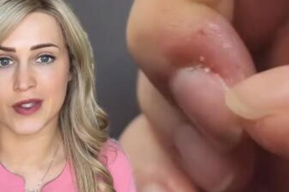 DOKTORKA DANA UPOZORILA DA GRICKANJE ZANOKTICA MOŽE DA IZAZOVE BOLEST: Retko ko je čuo za nju, a ovako se JAVLJA