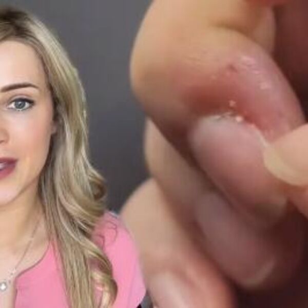 DOKTORKA DANA UPOZORILA DA GRICKANJE ZANOKTICA MOŽE DA IZAZOVE BOLEST: Retko ko je čuo za nju, a ovako se JAVLJA