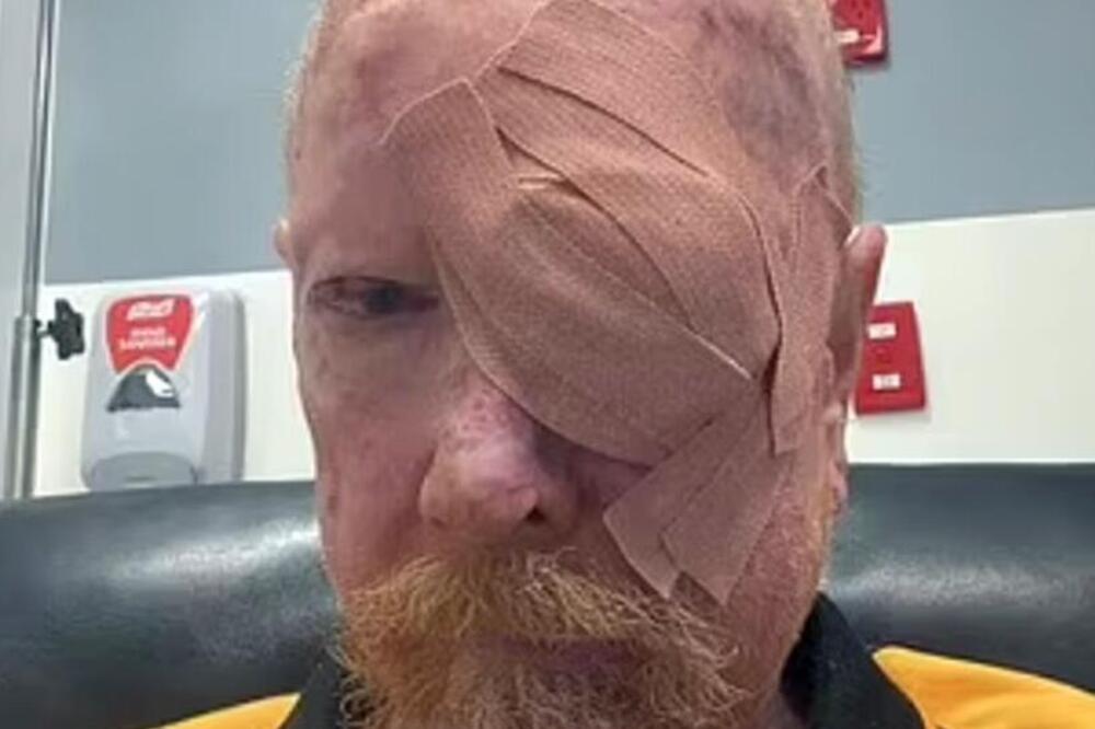 OVAJ ČOVEK IMA 200 TUMORA PO GLAVI I RUKAMA: Radio je po SUNCU GODINAMA, evo kako izgleda POSLE OPERACIJE (FOTO)