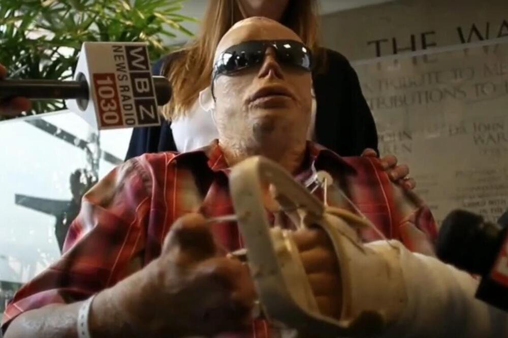 IZGOREO U STRAVIČNOM POŽARU U KLUBU, TRI PUTA UMIRAO NA STOLU, A ONDA SE PROBUDIO IZ KOME: Usledio ŠOK ŽIVOTA