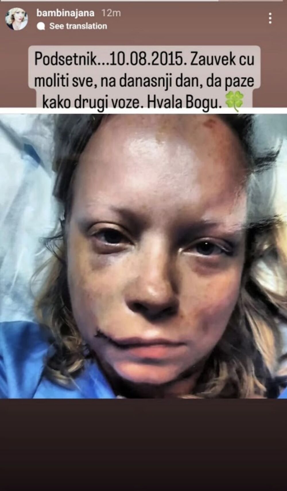 Ona je tada podelila fotografiju na kojoj je vidimo sa stravičnim povredama