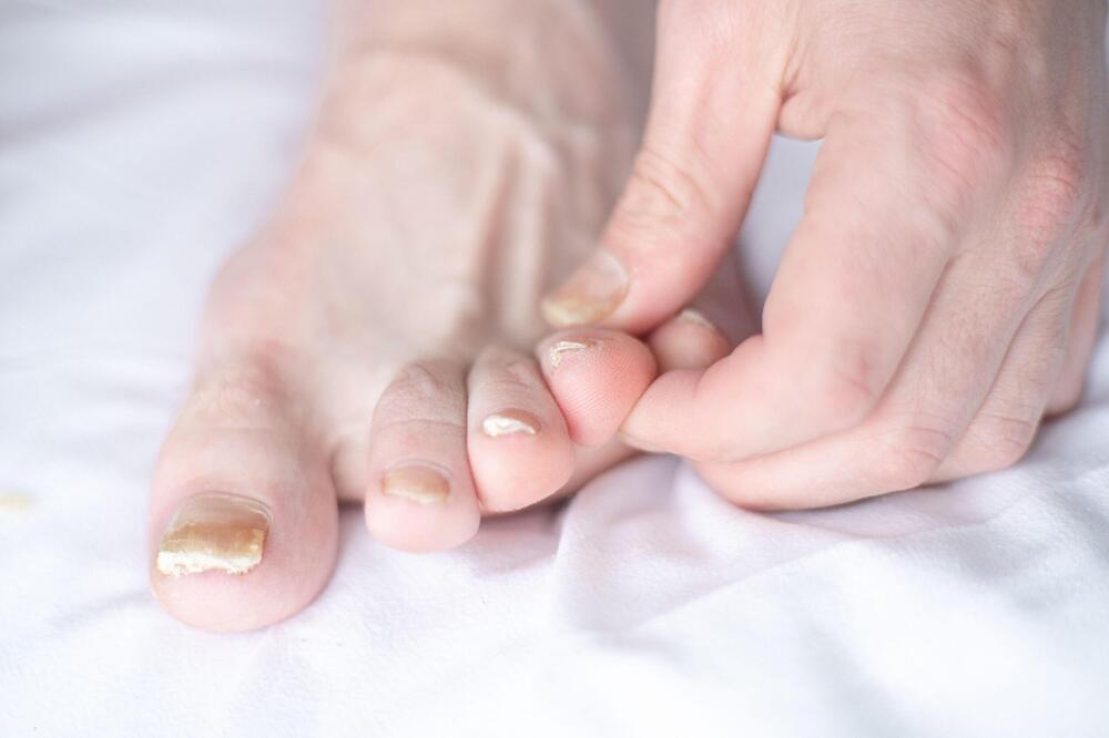 GLJIVIČNU INFEKCIJU NOKTIJU MOŽETE ZALEČITI I SRESTVIMA KOJE VEĆ IMATE U KUHINJI: Evo kako ćete se rešiti bolesti