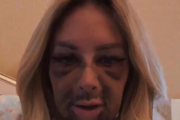 ZUBAR UNIŠTIO LICE POZNATOJ MANEKENKI, OGLASILA SE I SVE POKAZALA JAVNO: Celo lice joj je u MODRICAMA, užas (VIDEO)