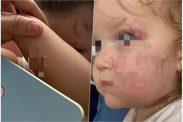 UŽAS U SREMSKOJ MITROVICI: Dete napalo i UZUJEDALO vršnjakinju