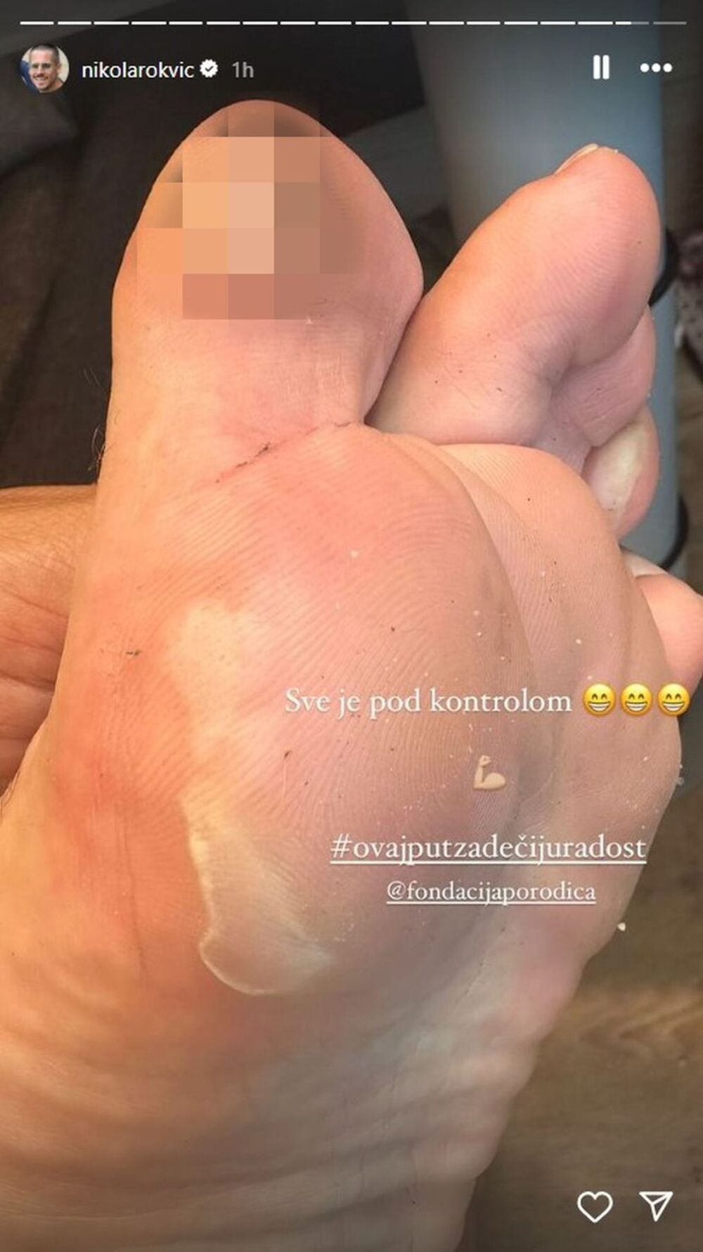 Nikola Rokvić pokazao povredu