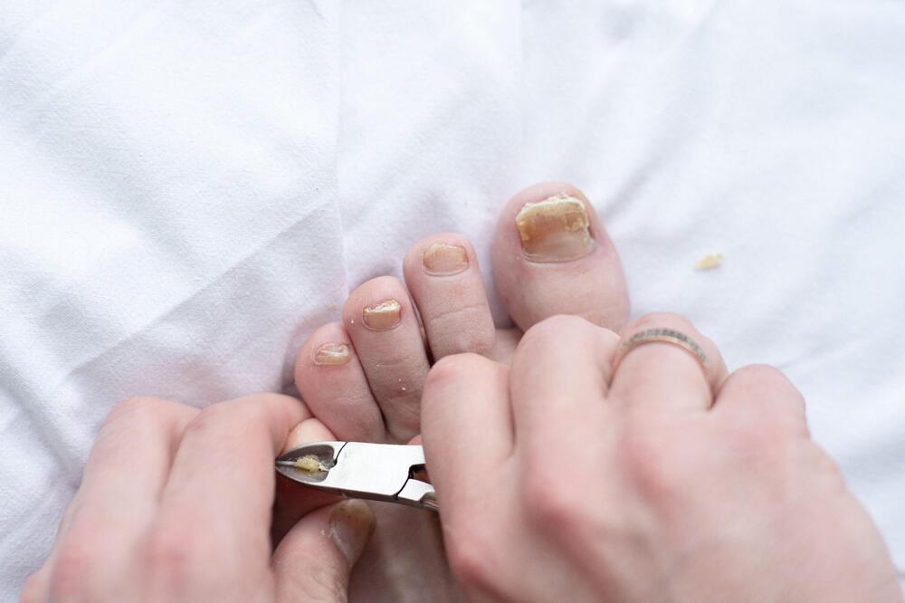 KAKO DA TRETIRATE GLJIVICE: Za zdrava i izlečena stopala i kožu uradite OVO!