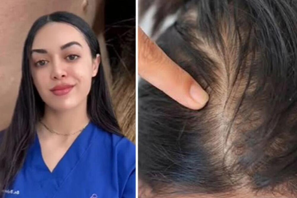 SIMPTOMI HORMONSKOG DISBALANSA KOJI SE NAJVIŠE JAVLJAJU KOD ŽENA: Ako primetite OVO NA GLAVI trčite kod lekara