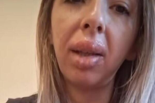 ŽAKLINA URADILA TRAJNU ŠMINKU USANA, A SADA SAMO MOŽE DA PIJE NA SLAMČICU: "Plačem ceo dan, UNAKAZILA me je!"