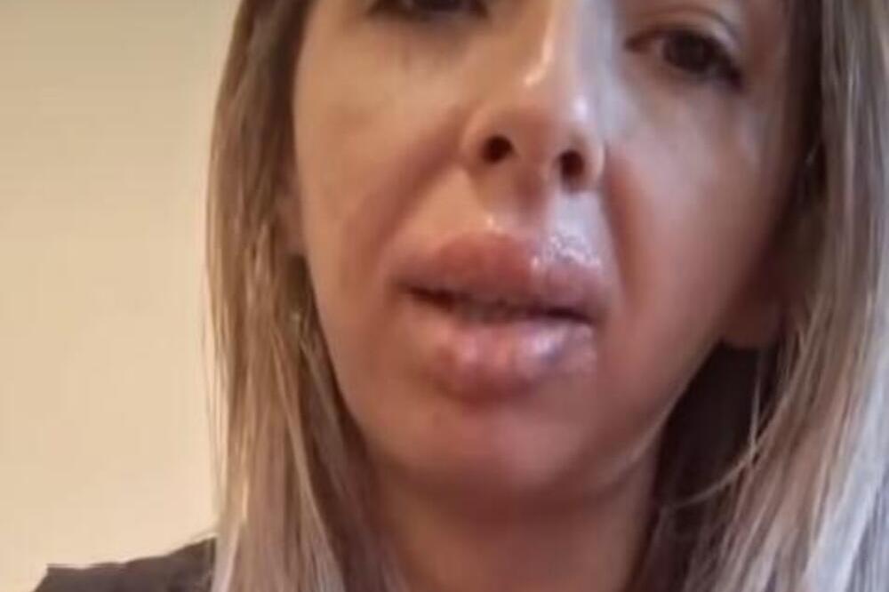 ŽAKLINA URADILA TRAJNU ŠMINKU USANA, A SADA SAMO MOŽE DA PIJE NA SLAMČICU: "Plačem ceo dan, UNAKAZILA me je!"