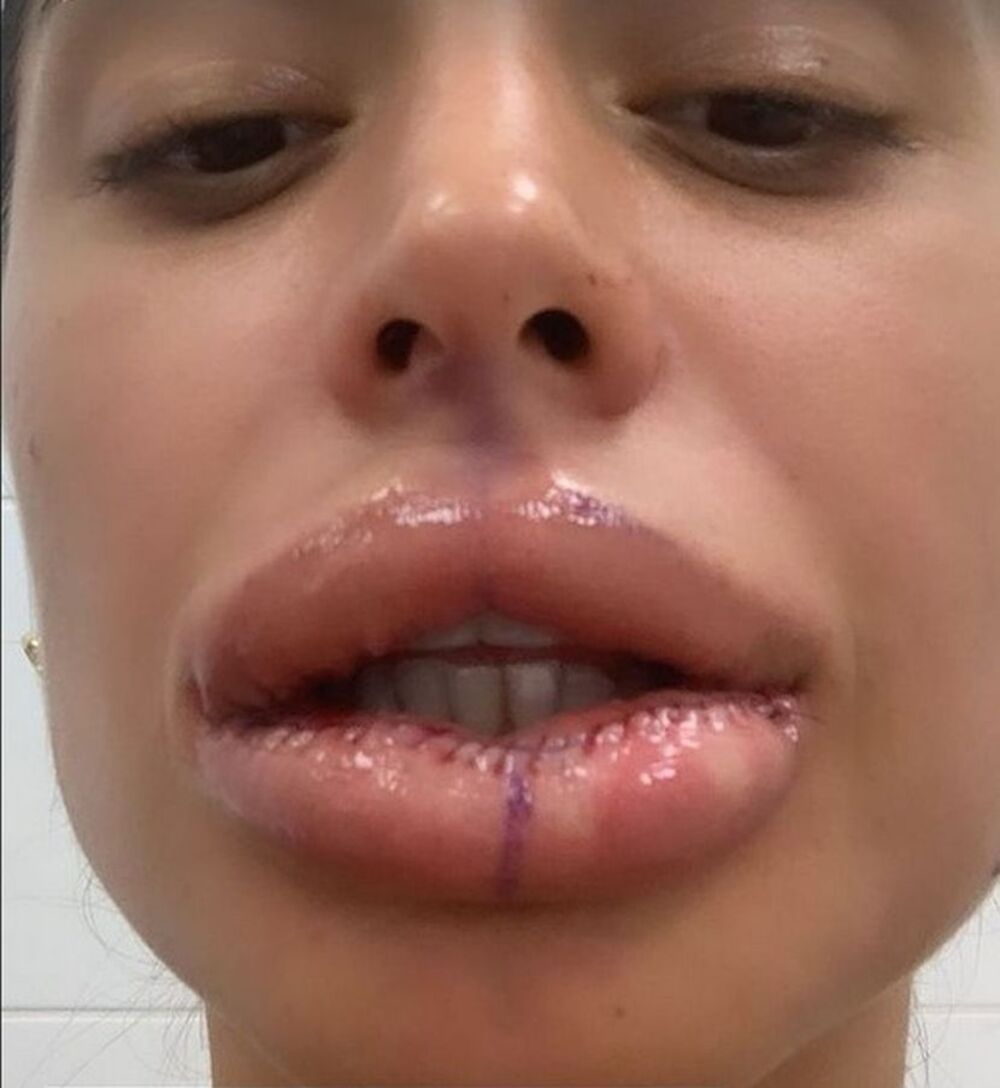 Sanja Grujić izvadila silikone iz usana