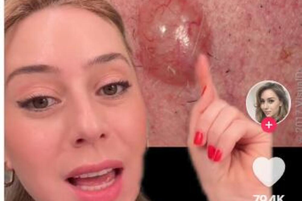 DERMATOLOŠKINJA OTKRILA SIMPTOME RAKA KOŽE NA LICU: Smrtonosniji je od svih drugih KARCINOMA ZAJEDNO (VIDEO)