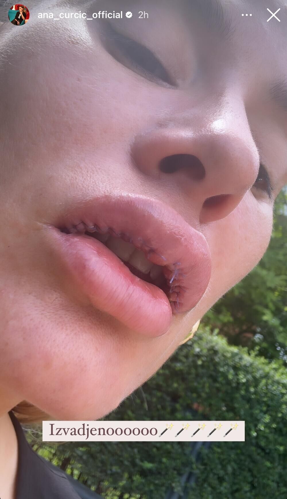 Ana Ćurčić izvadila silikone iz usana